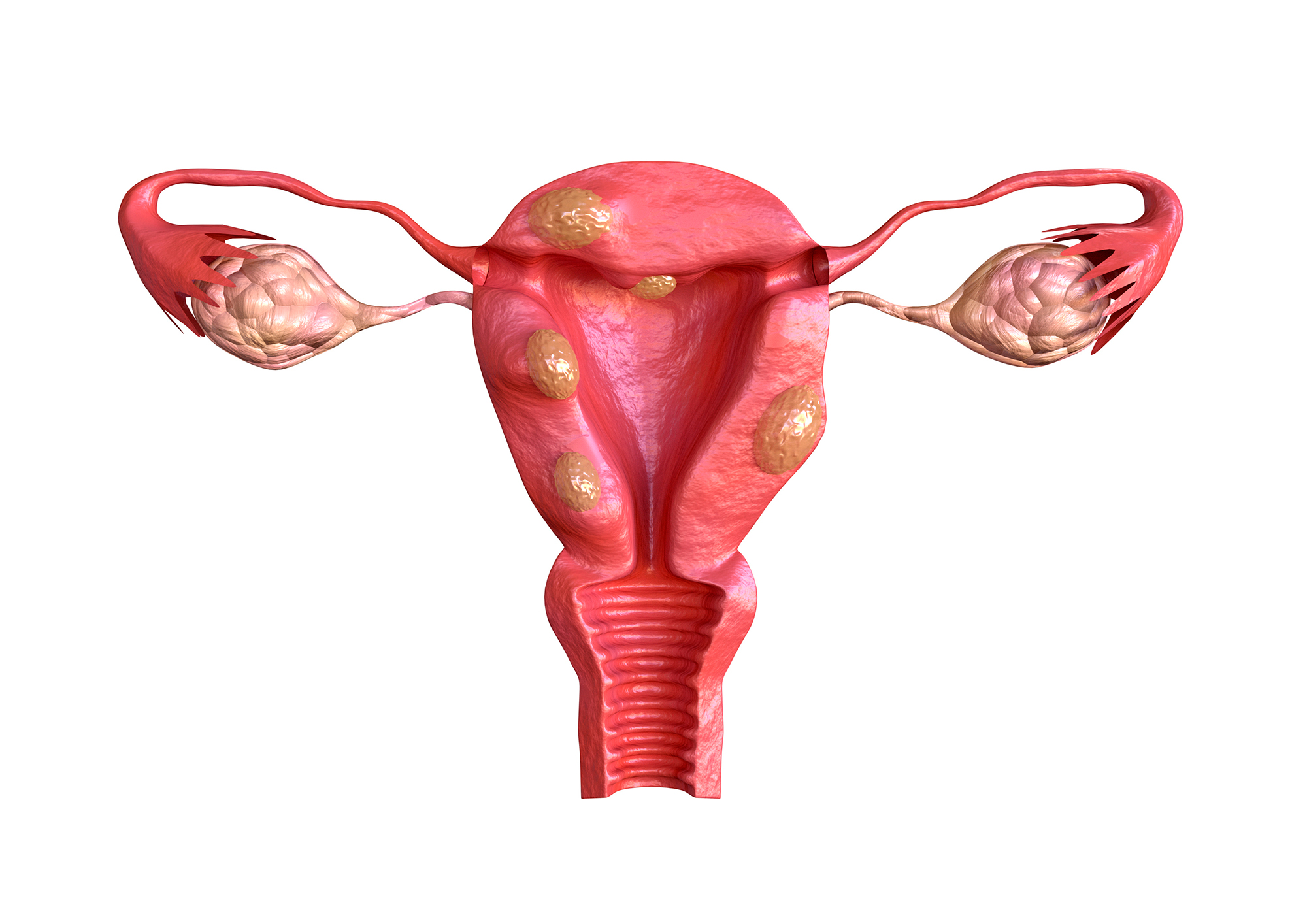 Fatores de risco para endometriose