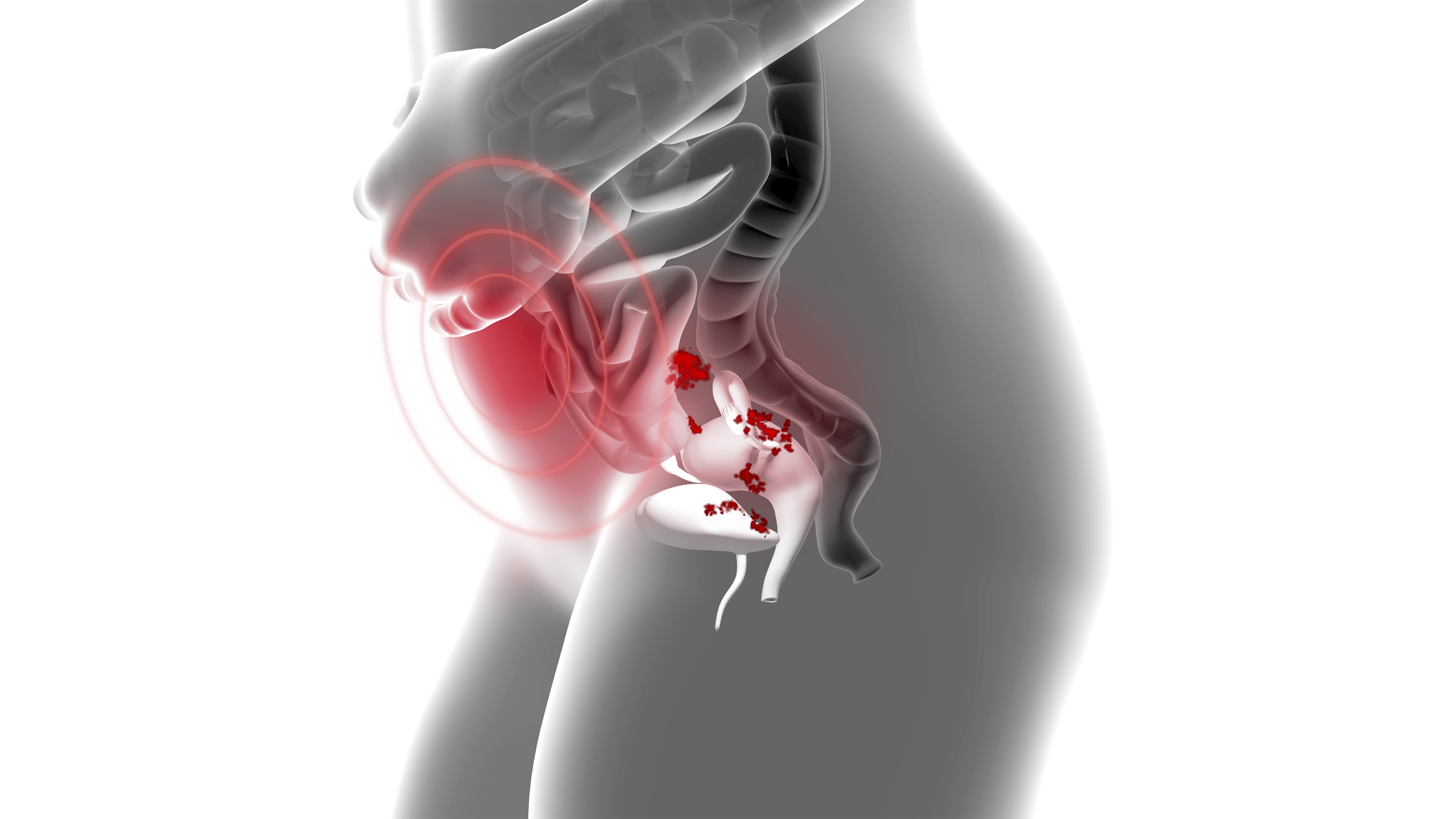 Endometriose intestinal: quando recorrer a cirurgia?